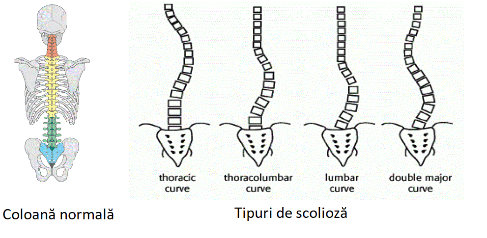 Coloana vertebrala stramba