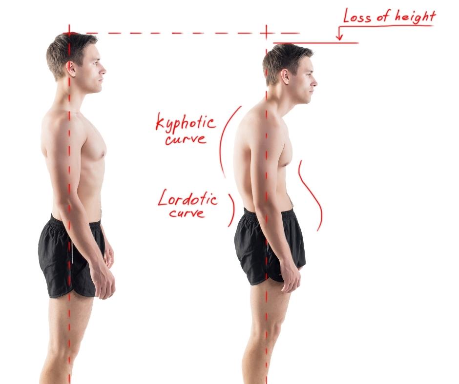 Durerile de genunchi,postură greșită și dezechilibre musculare